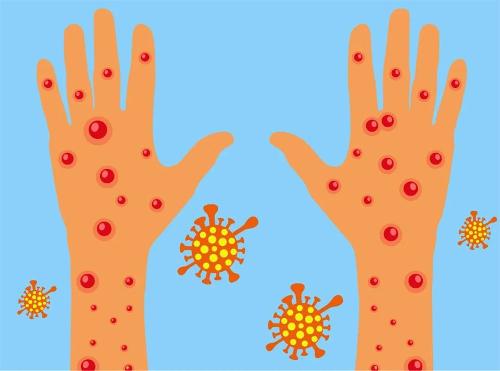 猴痘又刷“存在感”？科学预防不用恐慌！